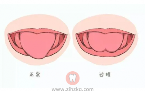 系带短及如何治疗系列专题大多数新生儿出生时,舌系带附着于舌腹前部