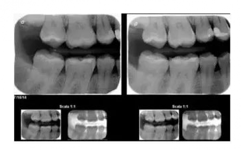 且配合牙医拍牙片有许多积极的意义,根据治疗的目的,牙医会选择拍摄