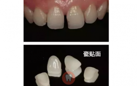 杭州牙贴面