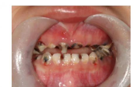 乳牙烂了一个洞引发骨髓炎