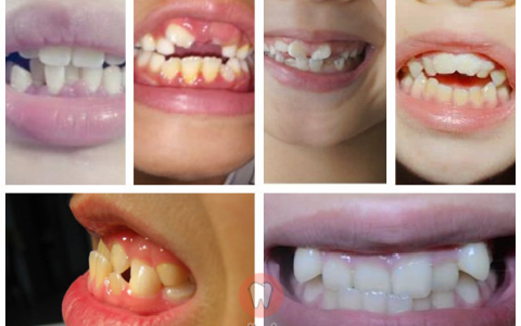 儿童牙齿不齐真实照片