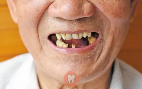 老年人缺牙危害