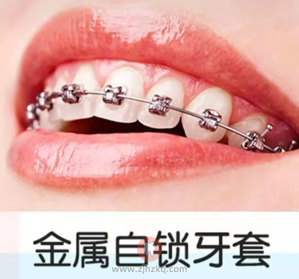 金属自锁牙套优缺点