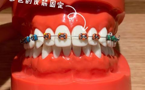 金属非自锁托槽矫正牙套图片【优点】:传统的金属托槽牙套矫正力度强