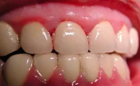 牙龈炎照片图片和症状
