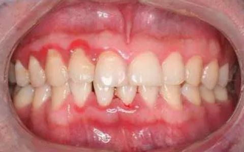 早期牙周炎照片图片和症状             早期牙周炎:除牙龈