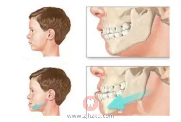 可以推荐杭州几家做地包天很棒的医院吗？