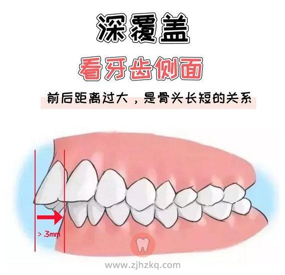 杭州深覆合怎么矫正？