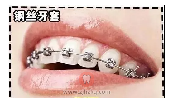 杭州正畸哪家医院最靠谱？