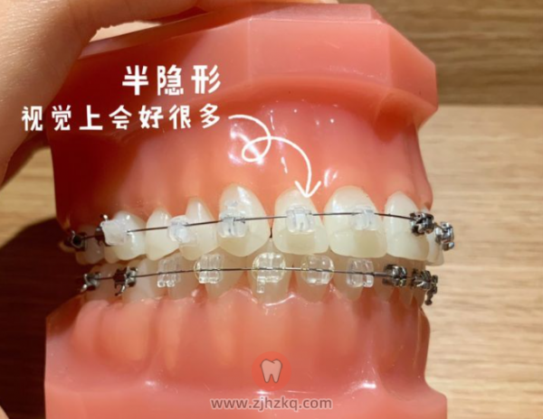 杭州陶瓷牙套价格费用到底是多少？