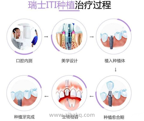 杭州种植牙过程图