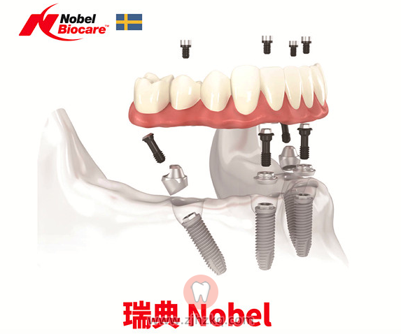 杭州瑞典诺贝尔种植体好不好用的人多吗？