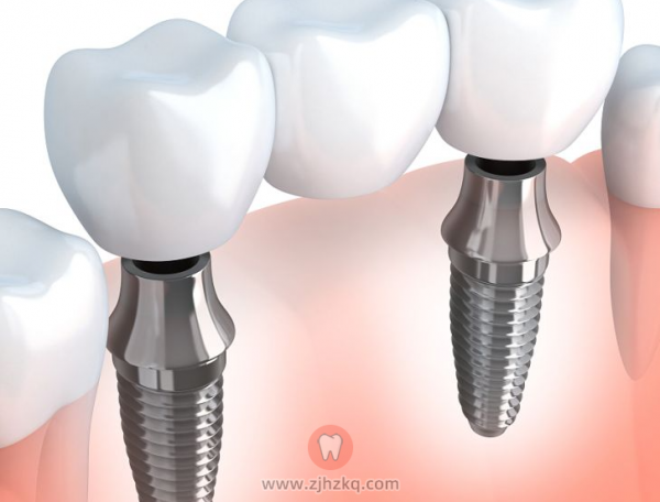 杭州种牙种植牙如何选择牙冠？