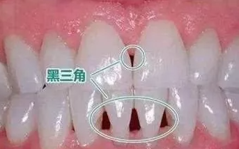 杭州牙齿矫正后牙龈萎缩怎么办？