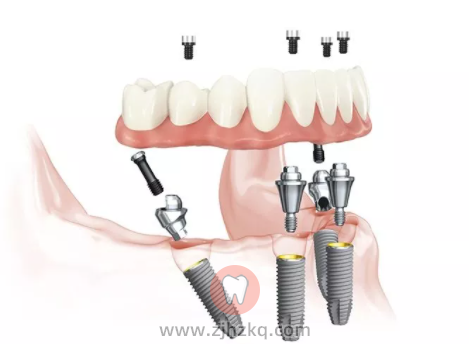 杭州即刻种植牙流程