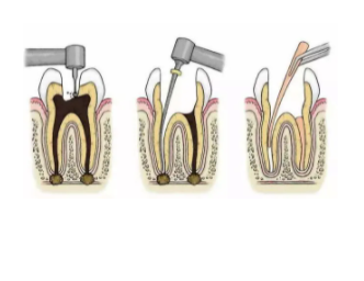 杭州牙医为啥补牙就要求做根管治疗？