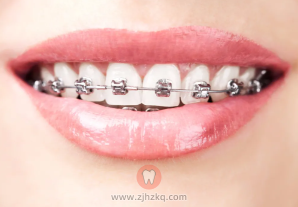 杭州正畸成人矫正牙齿有风险吗？