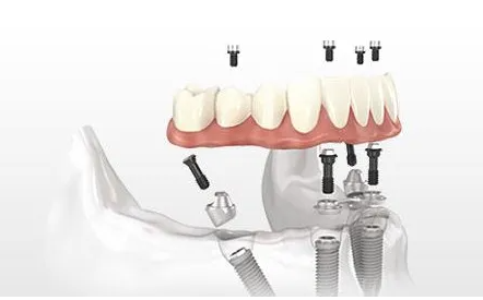 杭州All-on-4种植牙哪家医院可以做？