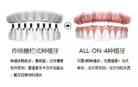 杭州All-on-4 种植牙靠谱吗？能用多少年？