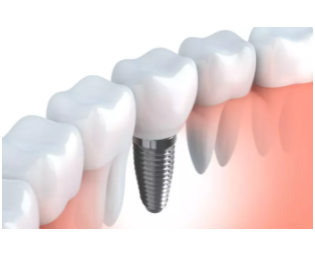 杭州哪些医院可以做种植牙？