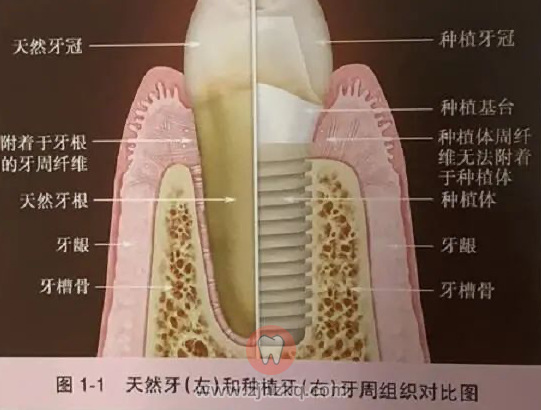 种植牙与正常牙的区别是什么？