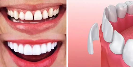 杭州牙齿贴面价格4000一颗贵吗？