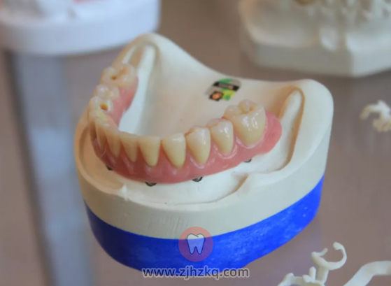 杭州好点的口腔医院全瓷牙套收费标准多少钱