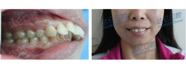 杭州牙齿深覆合深覆盖正畸医生推荐