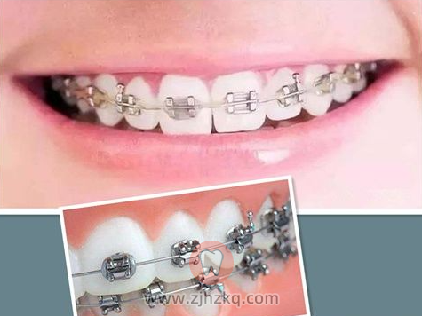 杭州市区牙齿矫正最便宜要多少钱？