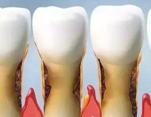 杭州牙医医院推荐洗牙洁牙