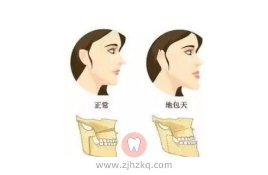 杭州地包天危害