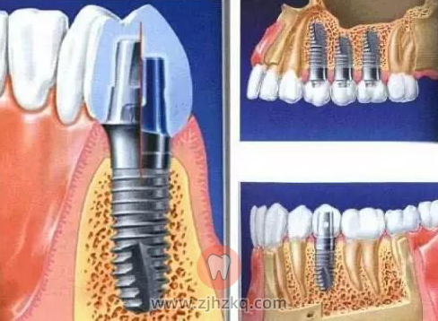 杭州医院种植牙核磁共振