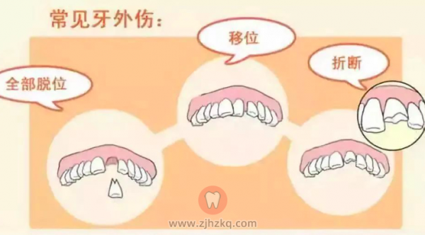 孩子门牙牙齿磕掉一块折断了去杭州什么医院