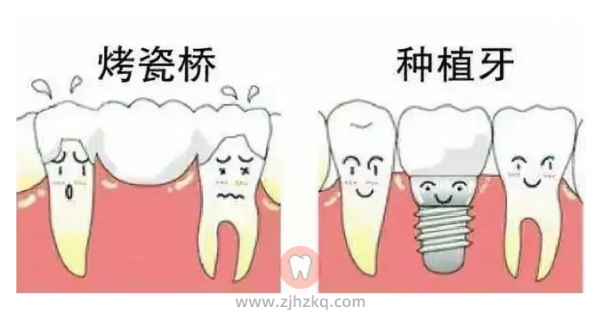 种植牙烤瓷牙区别图