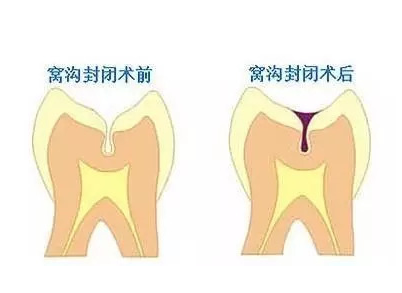 杭州免费窝沟封闭效果如何