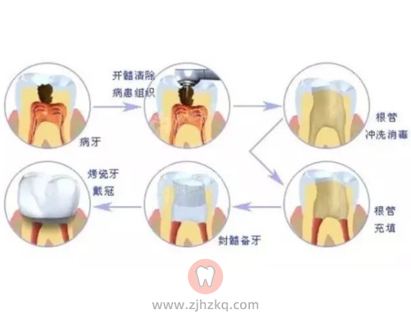 杭州根管治疗后要求配烤瓷全瓷牙冠