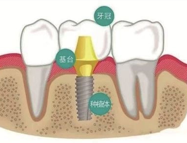 杭州老年人种牙年龄限制