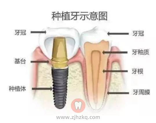 为什么杭州口腔医生推荐种植牙