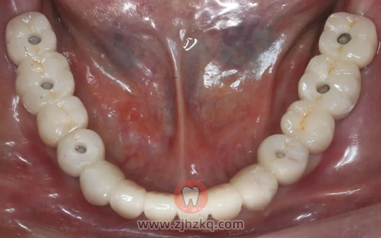 种植义齿半口种植牙真实图片