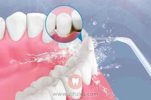 杭州洗牙去**还是**