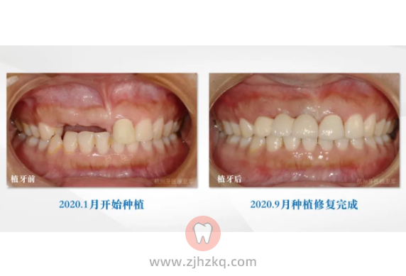 杭州天晖口腔顾亚军种牙水平