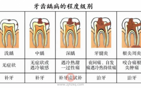 牙齿洞型分类及图片图片