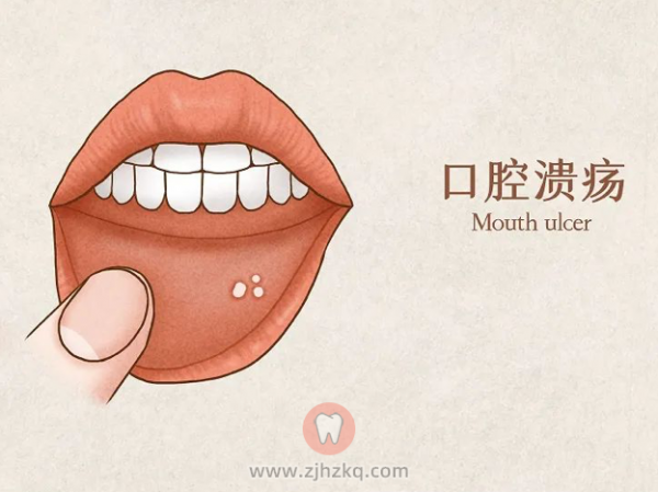 口腔溃疡口腔癌早期症状区别图
