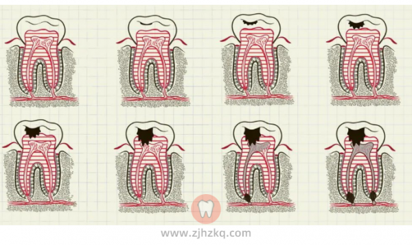 杭州补牙价格材料收费标准