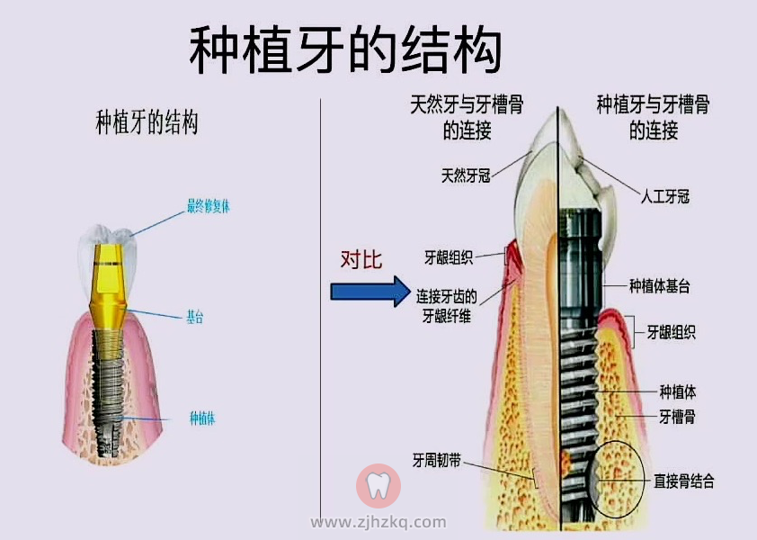 种植牙结构图高清