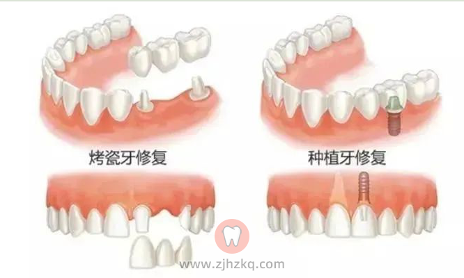 杭州种植牙烤瓷牙哪个更好