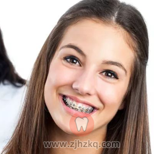 牙齿矫正自锁牙套非自锁牙套区别