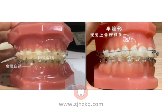 金属自锁牙套陶瓷自锁牙套区别