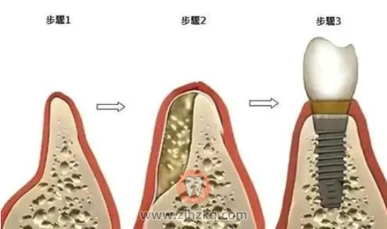 杭州种植牙骨粉骨膜是否被骗