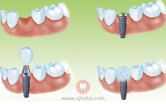 杭州种植牙科普专题